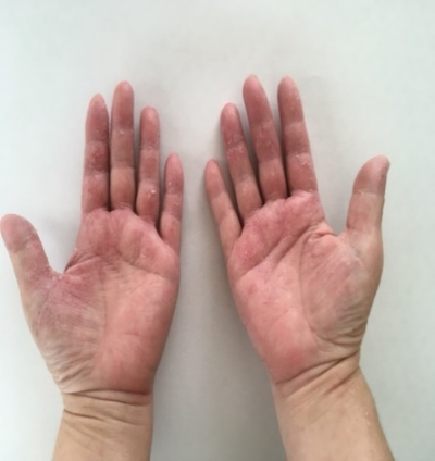 主婦湿疹の症例 Bさん