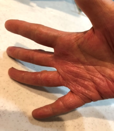 主婦湿疹の症例Aさん