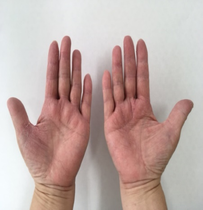 主婦湿疹の症例 Bさん