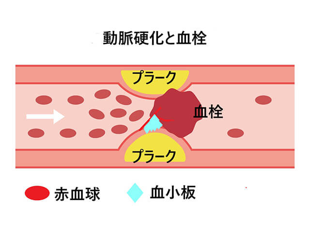 動脈硬化と血栓