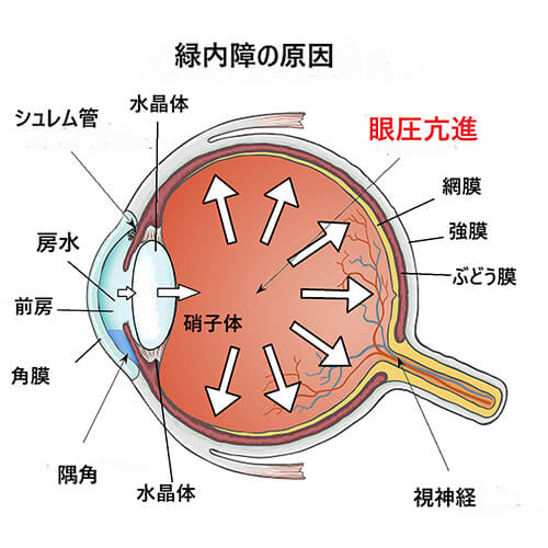 緑内障眼圧